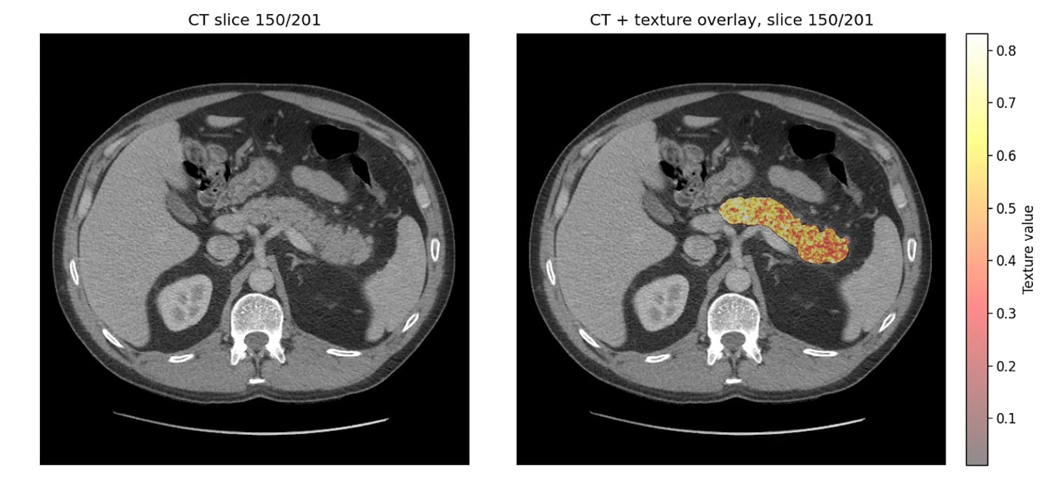 Mayo Clinic AI Detects Pancreatic Cancer Two Years Early